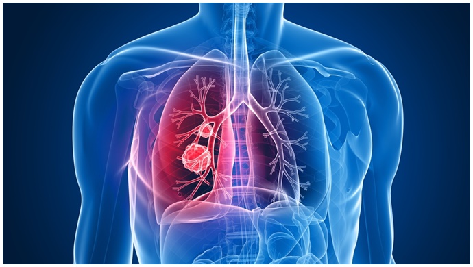 Akciğer Kanserinde Tedavi Başarısı Artıyor