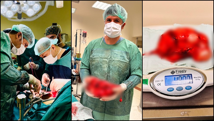 Şanlıurfa'da bir hastanın karnından 5 kilogramlık böbrek tümörü çıkarıldı-(VİDEO)